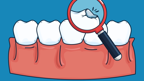 Beragam Penyebab Gigi Retak & Cara Mengatasinya